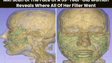 MRI Scan Of The Face Of A 33-Year-Old Woman Reveals Where All Of Her Filler Went