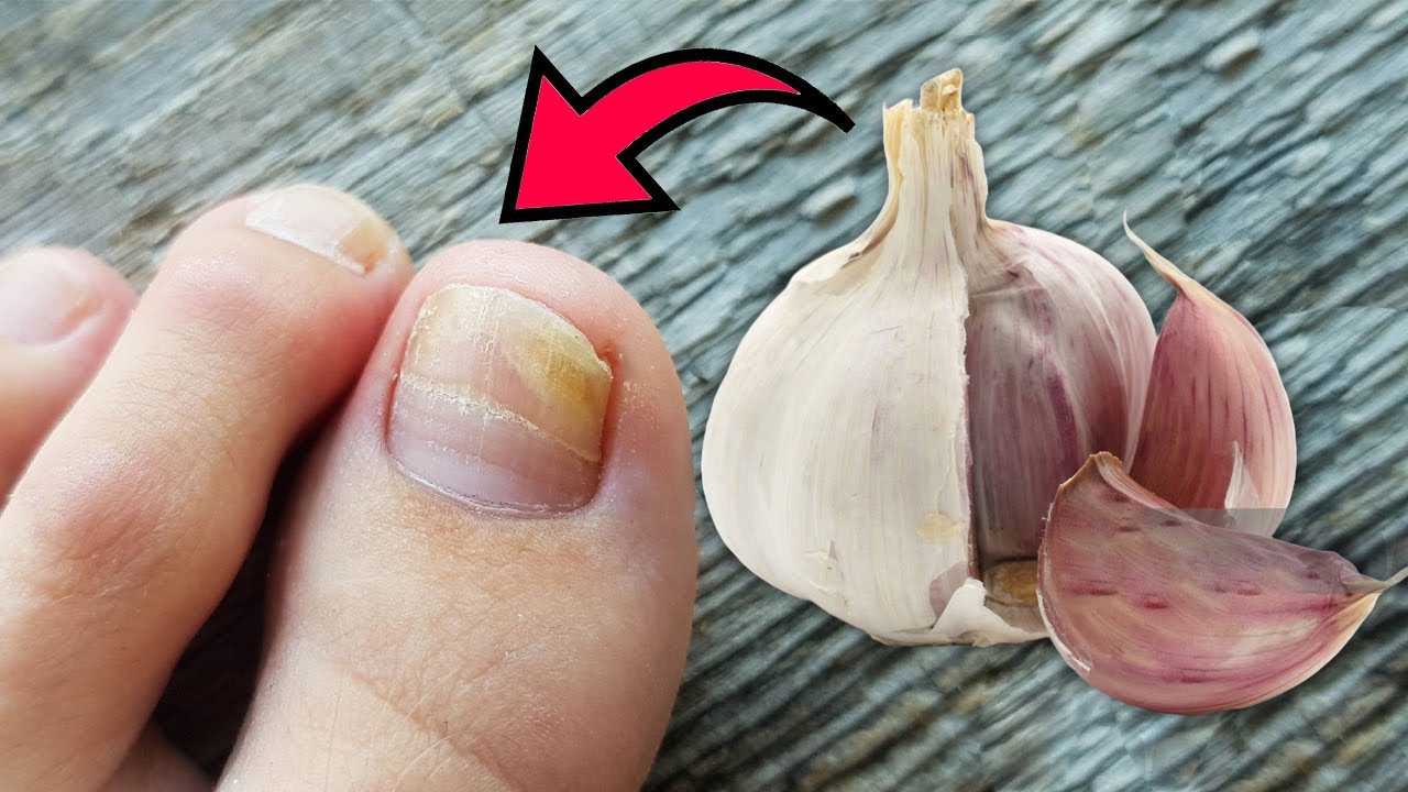 Erase Nail Fungus Naturally: Discover The Power Of Garlic