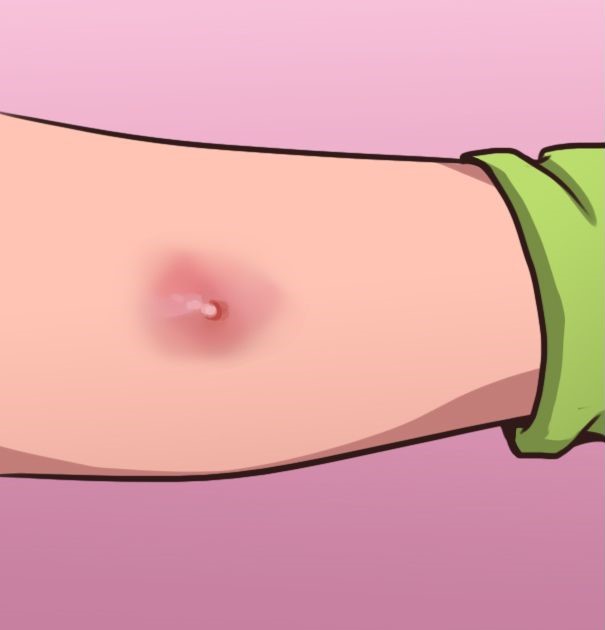 Boils Can Be Painful And Annoying But Heres How To Get Rid Of Them The Natural Way1