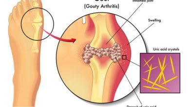 How To Quickly Remove Uric Acid Crystallization From Your Body To Prevent Gout And Joint Pain