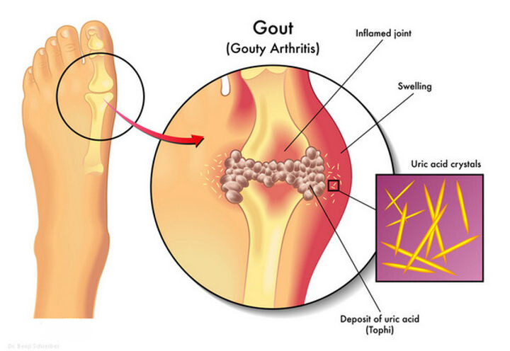 How To Quickly Remove Uric Acid Crystallization From Your Body To Prevent Gout And Joint Pain