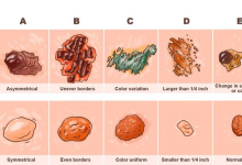 This skin cancer detector guide can save your life e1729567066586