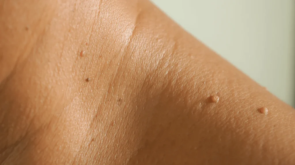 dermavel blog article skin tags hero 001 1 1024x576 1