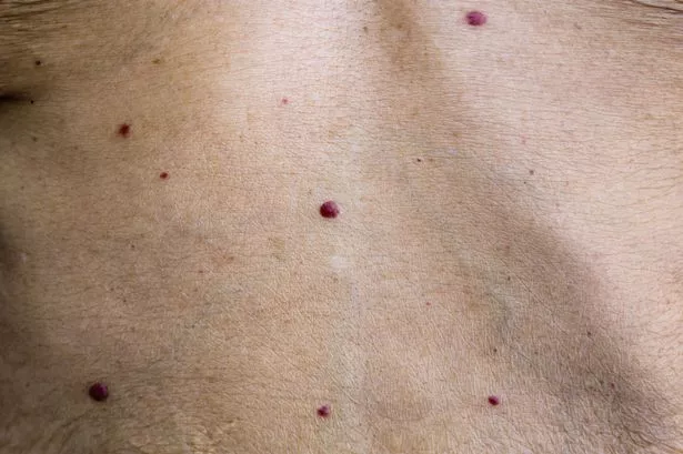 0 Red moles or cherry angiomas are common skin growths that can develop on most areas of your body