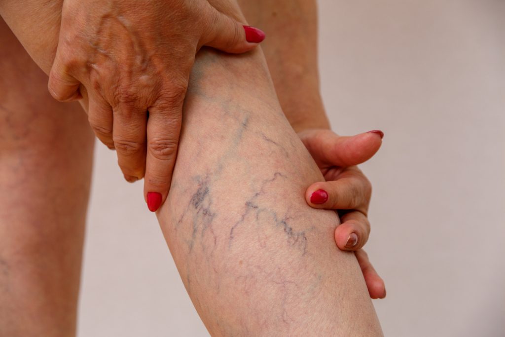 elderly woman with varicose veins on calf 1024x683 1