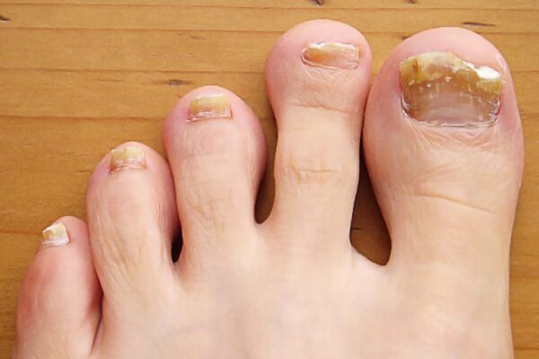 toe fungus resized 56a315a95f9b58b7d0d04d72 600x400 1