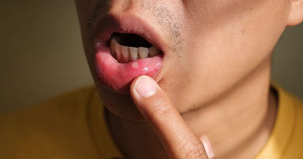 male mouth ulcer 1200 628 facebook 1200x628 11zon 1024x536 1