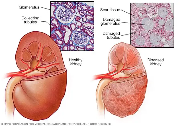 mcdc7 diseased kidney 8col