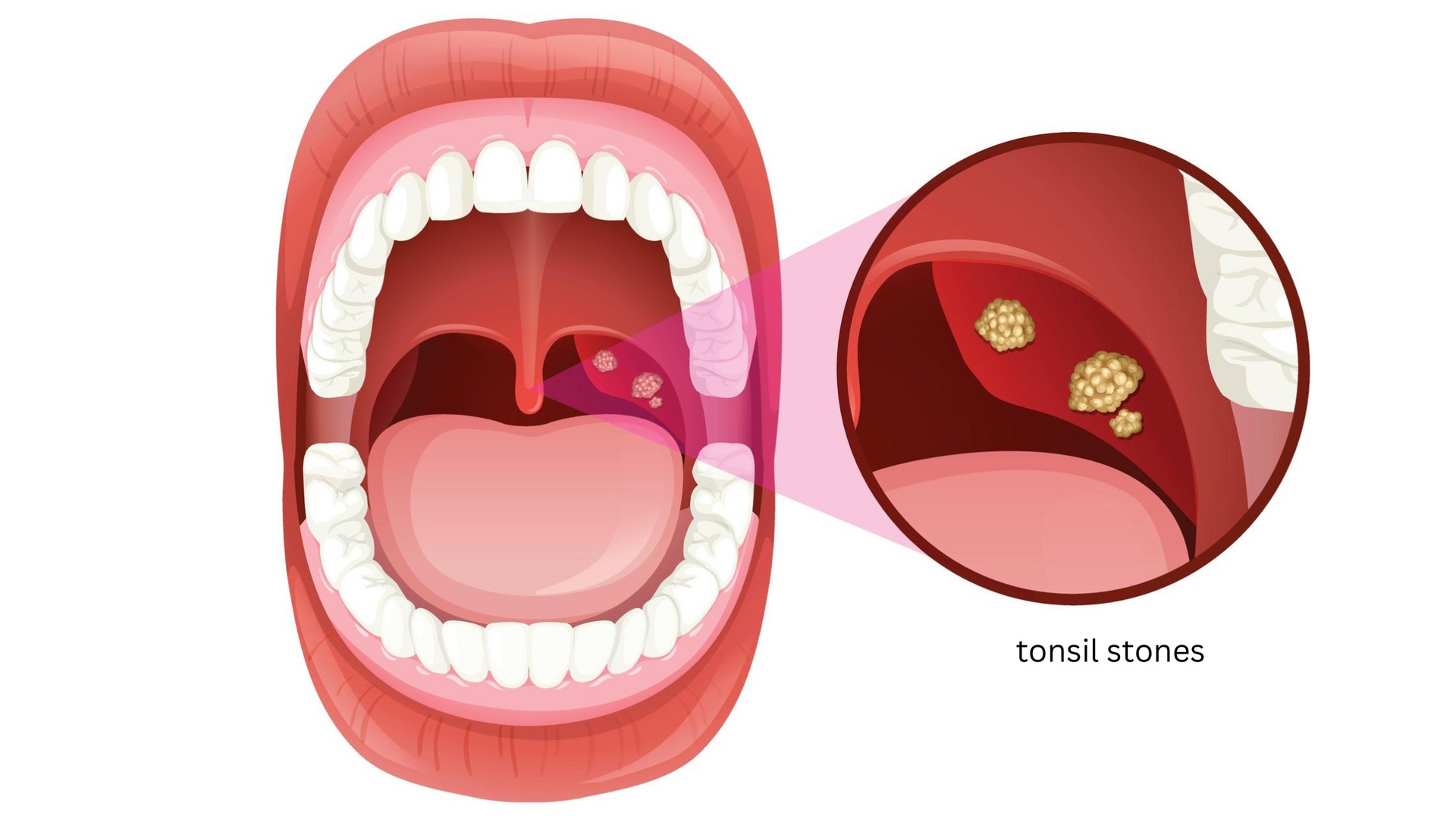 tonsil stones