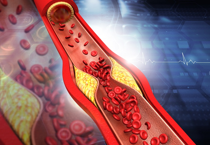 Top 3 Teas to Clear Out Your Arteries Naturally 2 2022 10 11
