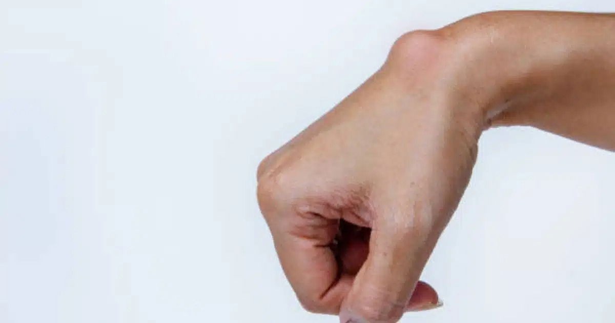 A cyst on the foot or wrist: What should you do? 3 For illustrative purpose only