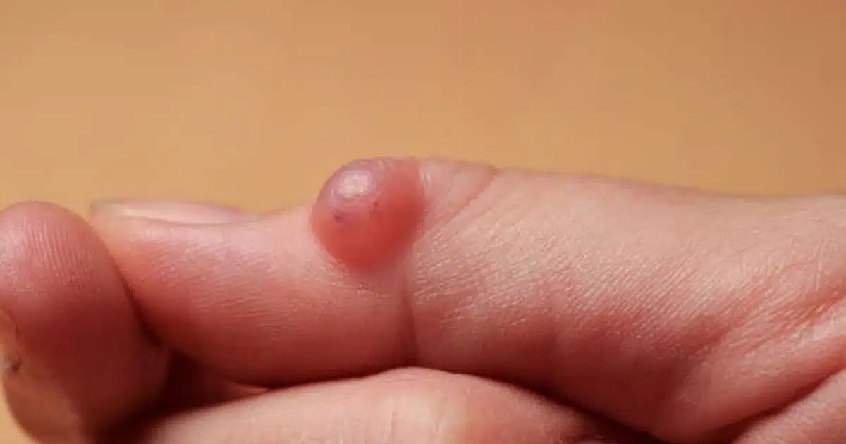 A cyst on the foot or wrist: What should you do? 2 For illustrative purpose only