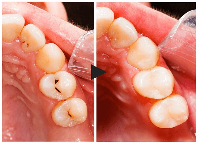 Ultimate Guide to Tooth Decay Se