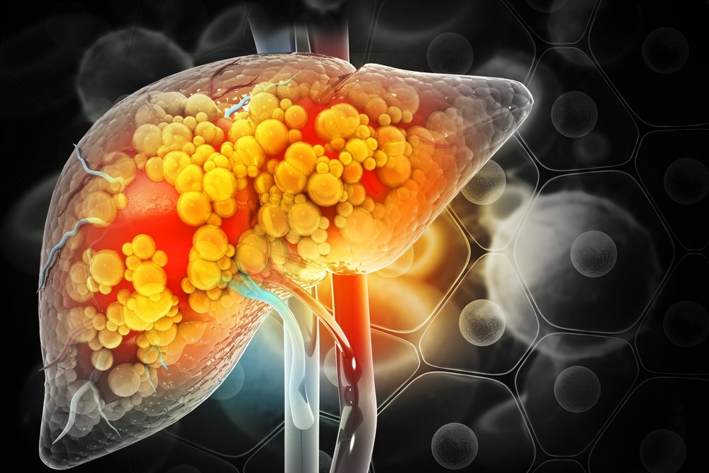 Early Signs of Fatty Liver Disease You Must Never Ignore 1 download 1 10