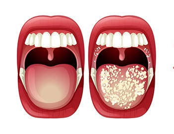 Early Signs of Oral Can-cer You Should Not Ignore 2 download 17 e1746609271772