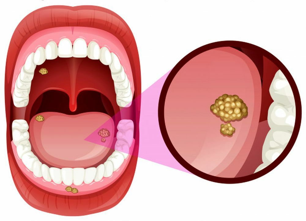 Early Signs of Oral Can-cer You Should Not Ignore 3 download 19