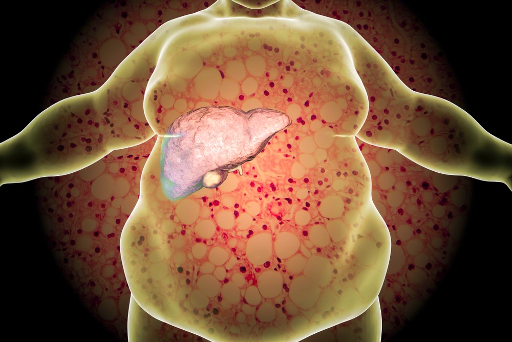 Early Signs of Fatty Liver Disease You Must Never Ignore 5 download 2 11