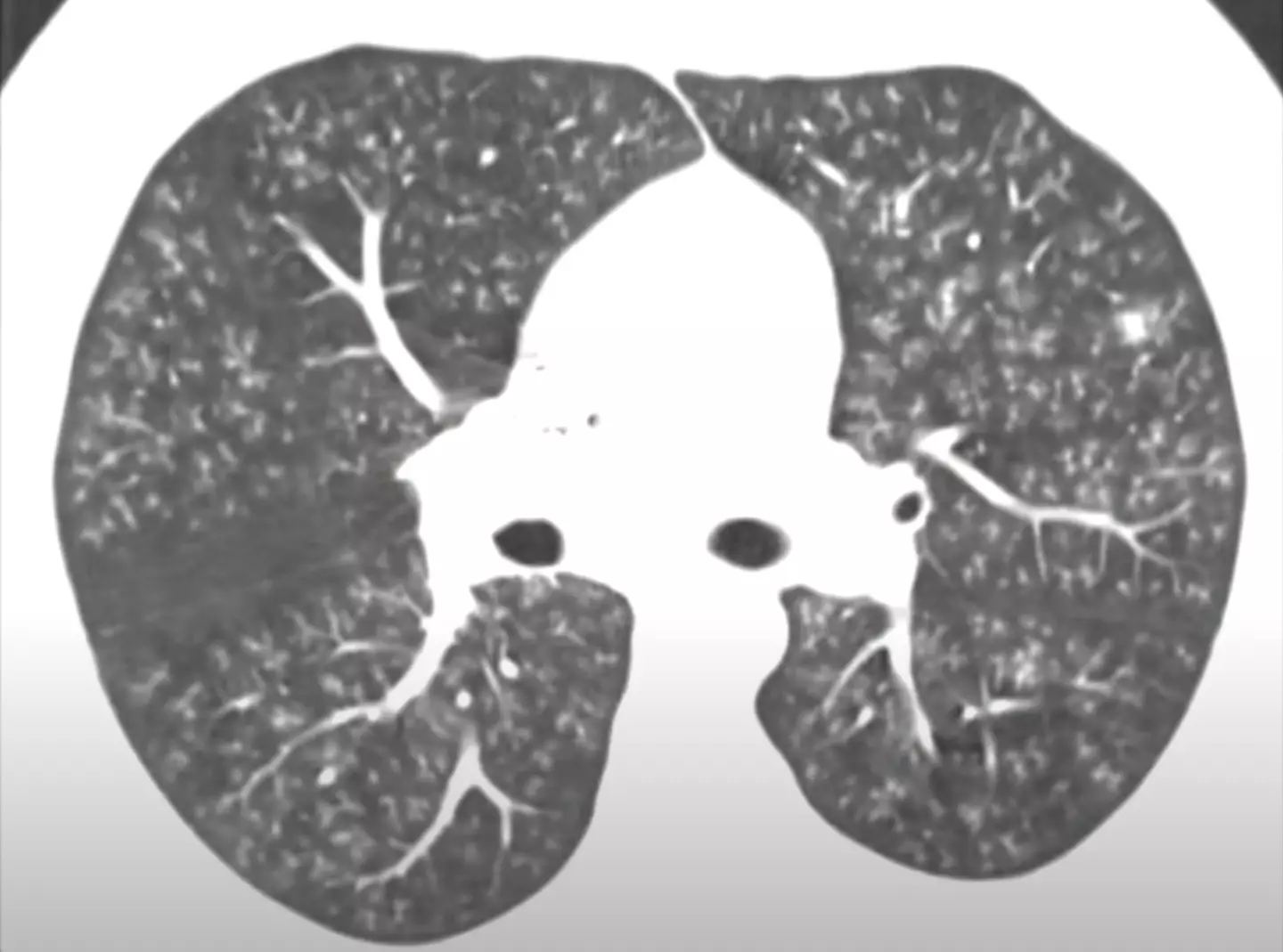 Health experts issue urgent warning over 'popcorn lung' 3 download 3