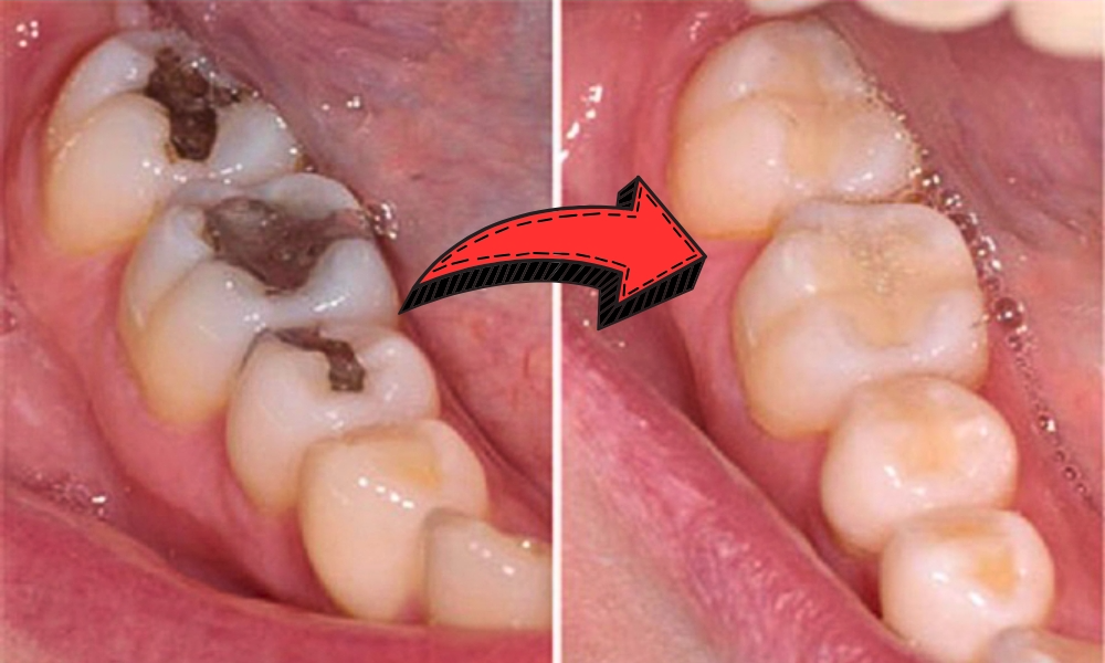 Naturally Support Your Teeth: 6 Safe Ways to Help Fight Early Decay and Strengthen Enamel 1 download 34 e1747448261506