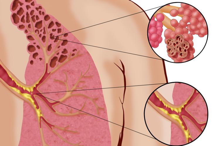 Health experts issue urgent warning over 'popcorn lung' 4 download 6